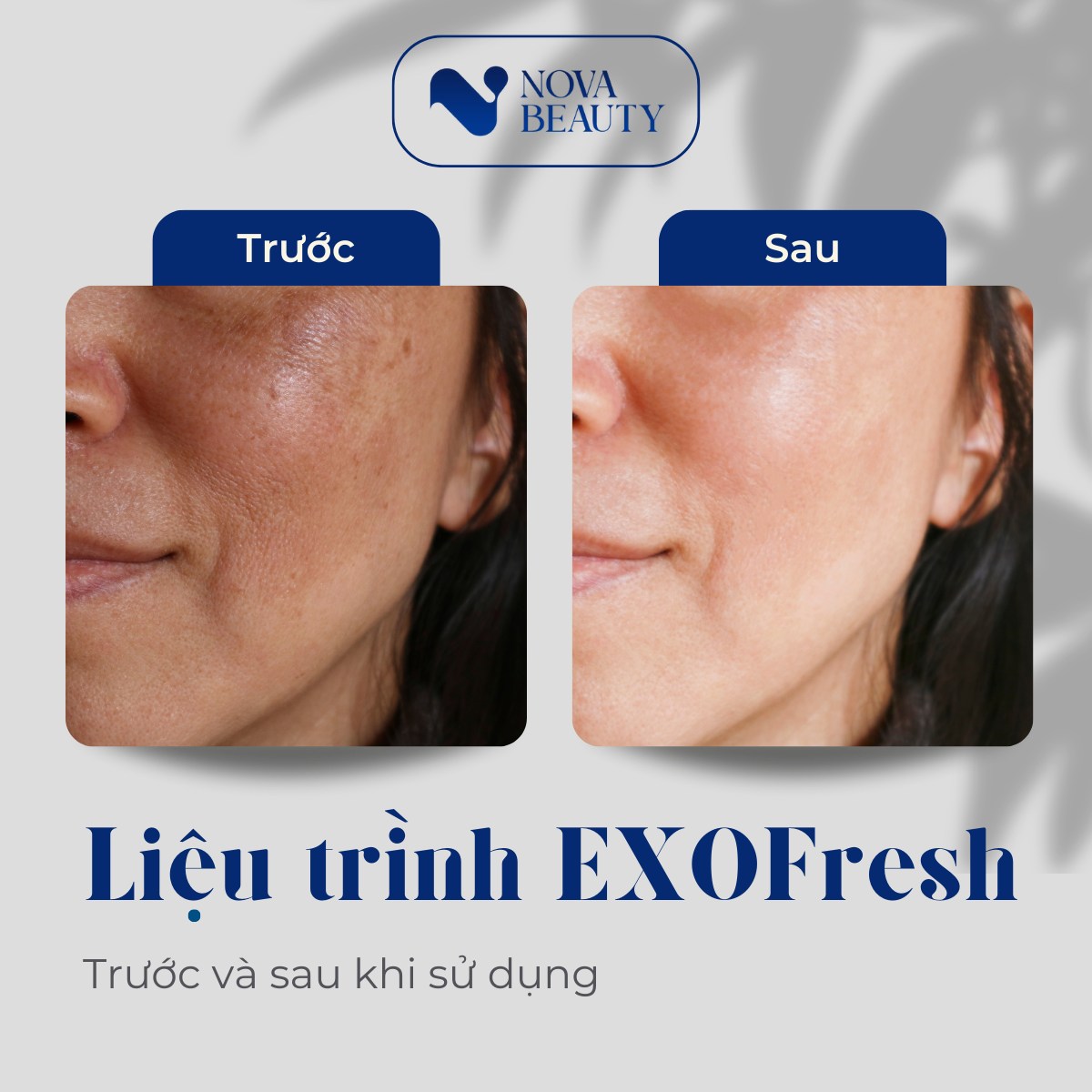 Tác dụng của ExoFresh với da nám 