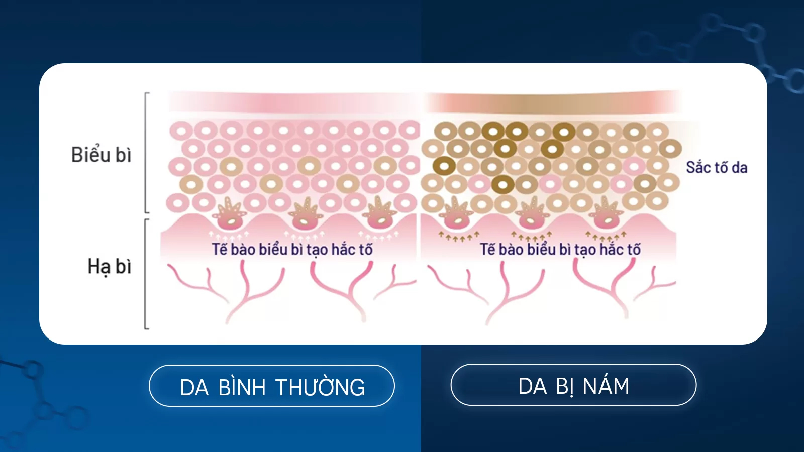 Trị nám tế bào gốc NovaBeauty 