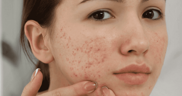 Sẹo rỗ do mụn viêm để lại trên da