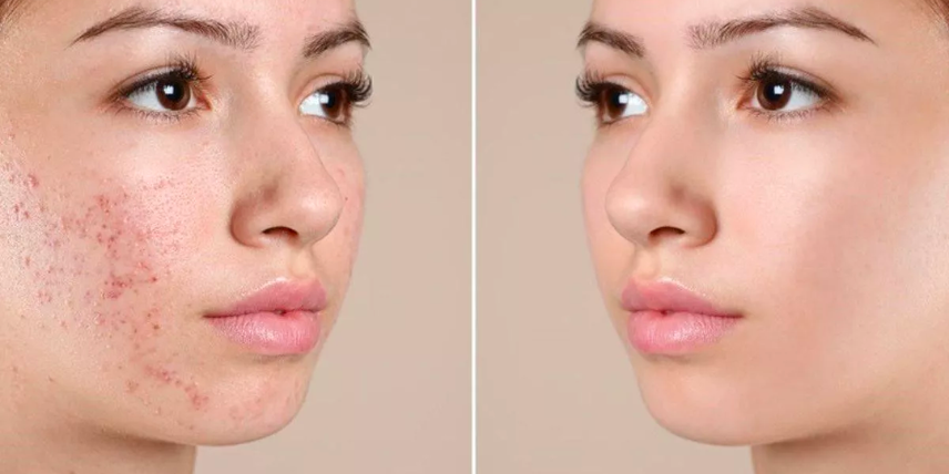 Ảnh: Trị mụn đồng thời với tái tạo da rút ngăn thời gian phục hồi