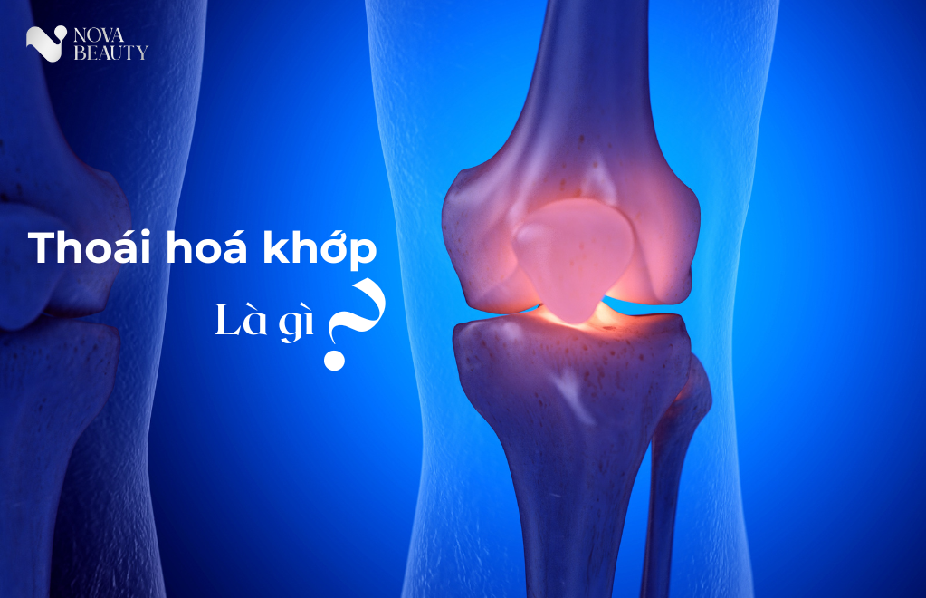 Khái niệm thoái hoá khớp