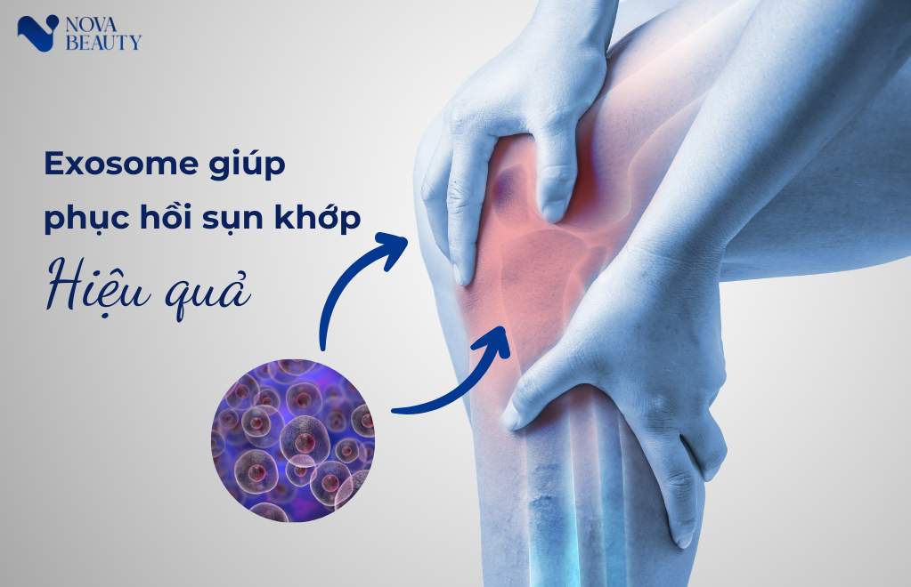 Chất tiết tế bào gốc exosome giúp phục hồi sụn khớp hiệu quả