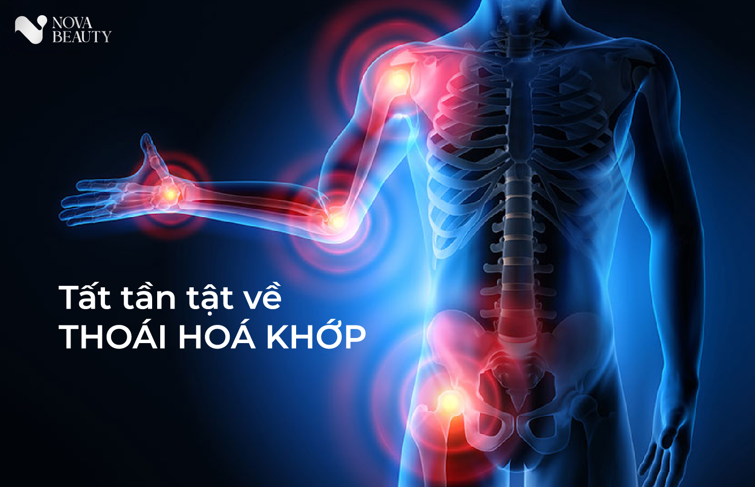 Tất tần tật về thoái hoá khớp