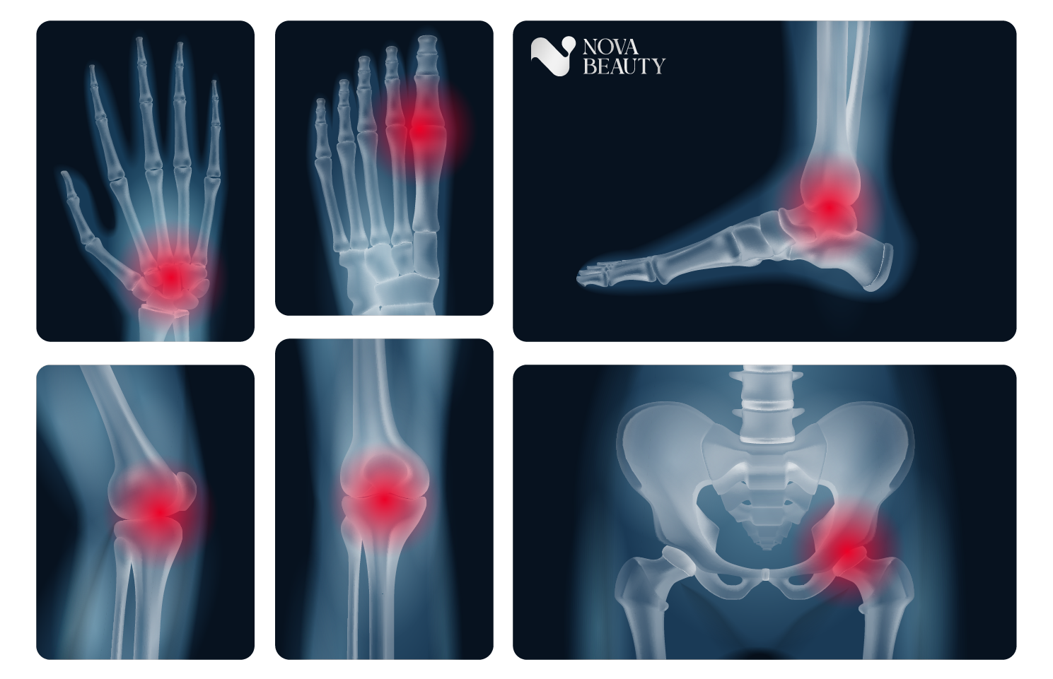 Thoái hoá khớp là gì?