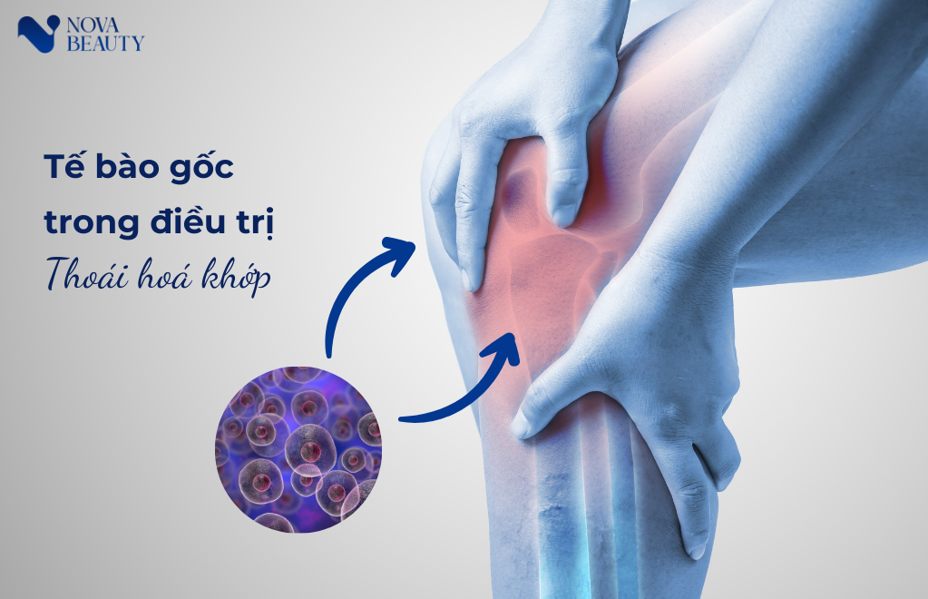 Tế bào gốc trong điều trị thoái hoá khớp